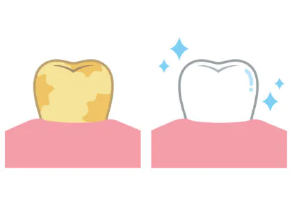 ホワイトニングのメリットとデメリット