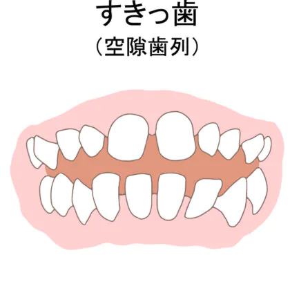 歯並びが悪い大人の特徴│大野城市・下大利駅近くの大野城もはら歯科