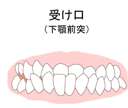 歯並びが悪い大人の特徴│大野城市・下大利駅近くの大野城もはら歯科