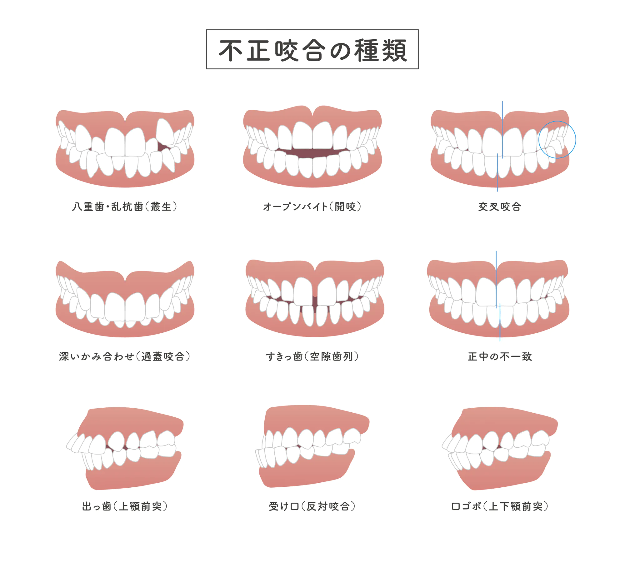 不正咬合の種類│大野城もはら歯科